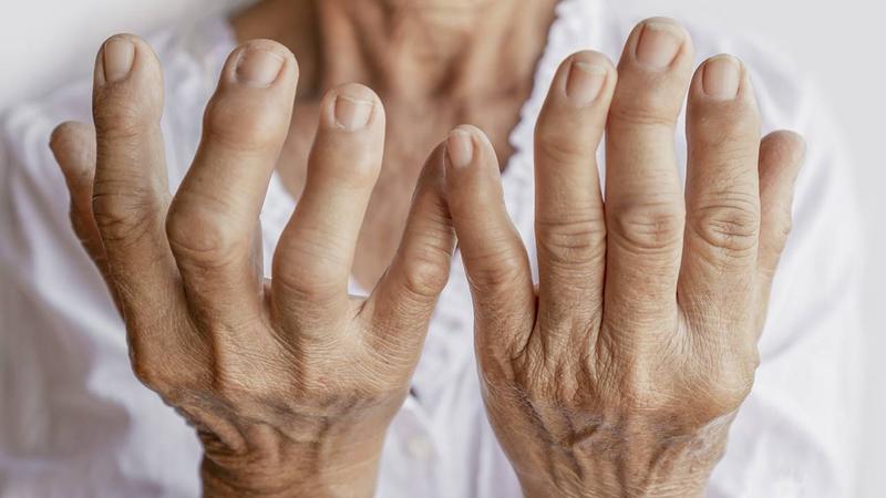 Artritis: causes, símptomes i tractament