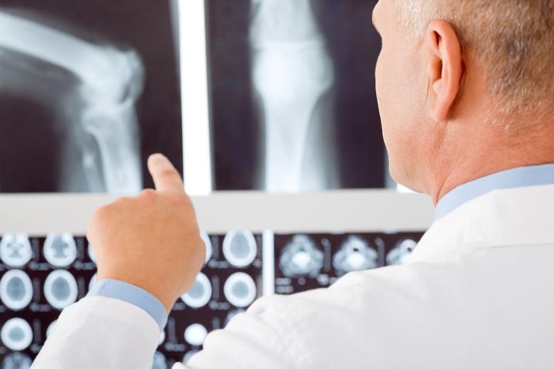 Síntomas, factores de riesgo y prevención de la osteoporosis