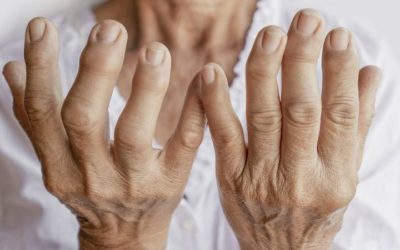 Artritis: causas, síntomas y tratamiento
